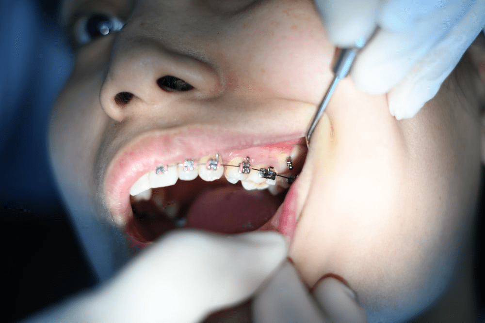 A mouth with braces getting dental treatment in Midland