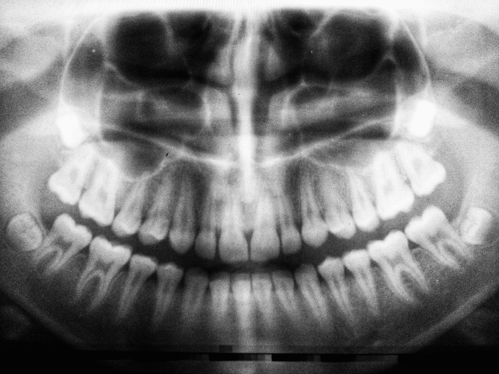 A x-ray of teeth